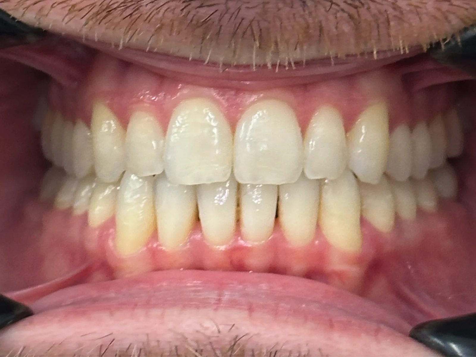 Close-up of straight, aligned teeth after Invisalign and composite veneers