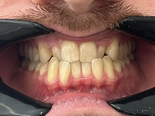 Close-up of crowded and misaligned teeth before Invisalign treatment