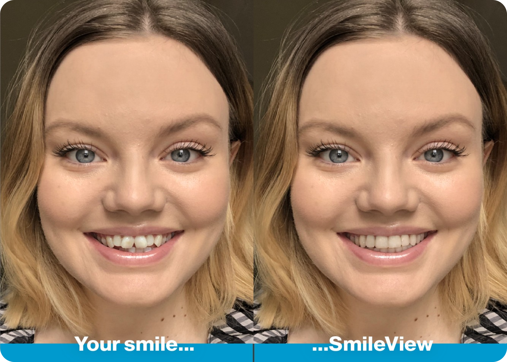 Trial your smile with Invisalign SmileView preview
