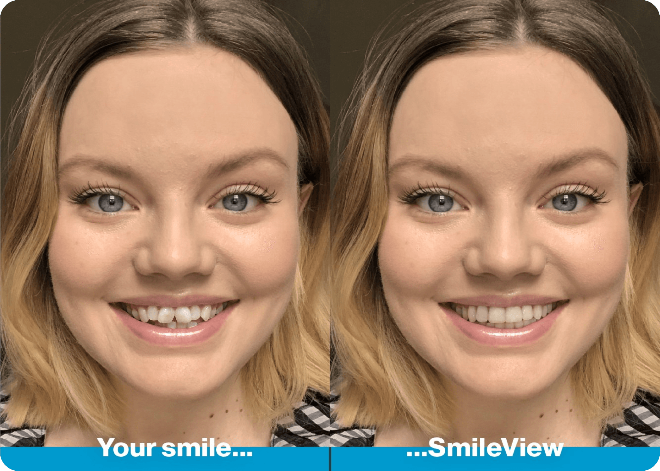 Trial your smile with Invisalign SmileView preview