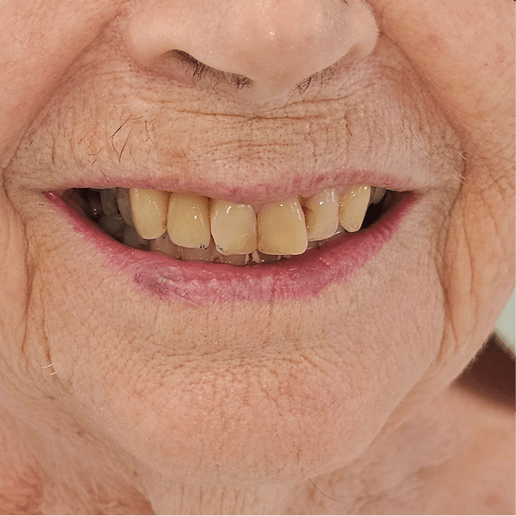 Before dental implants treatment - patient with missing tooth in Norwich