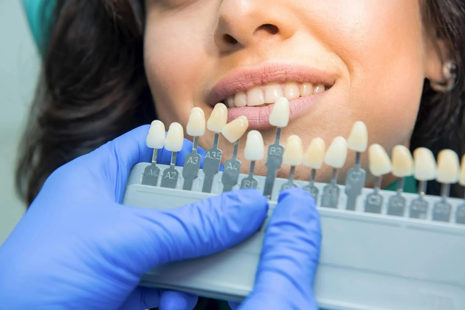 Professional teeth whitening at Taverham Dental, dentists Norwich after photo
