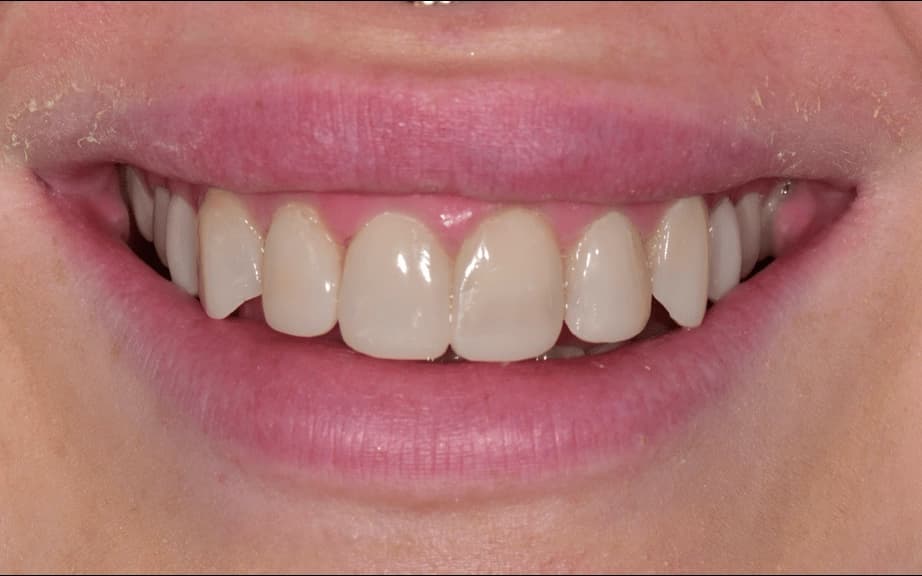 Composite veneers after photo