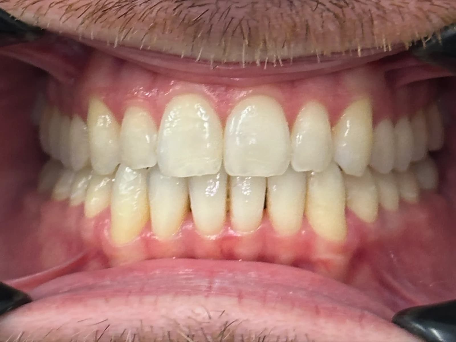 Transforming Smiles and Confidence: An Invisalign Case Study at Taverham Dental after photo
